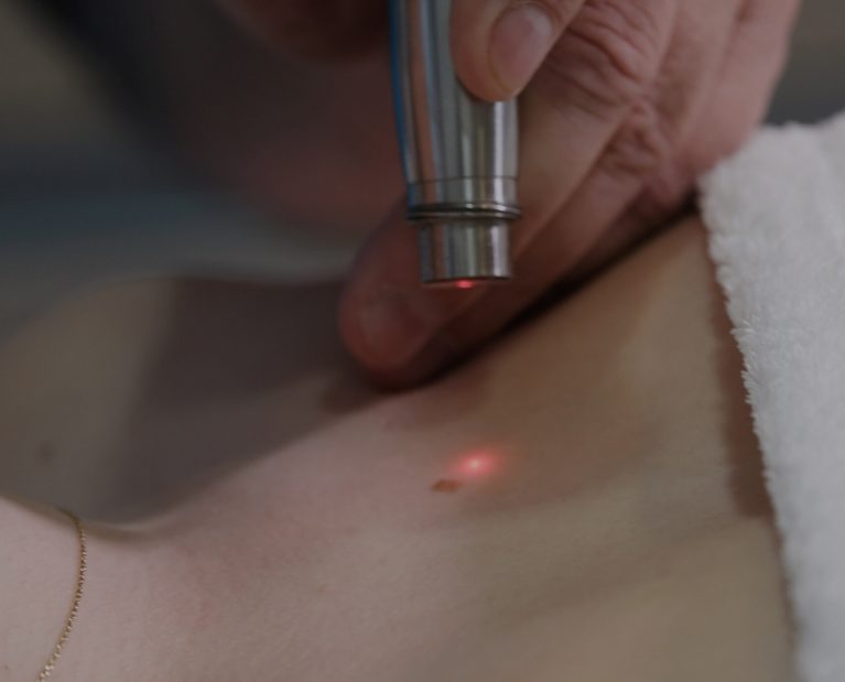 Lekársky zákrok ošetrenia hrudníka laserom pre pacienta.