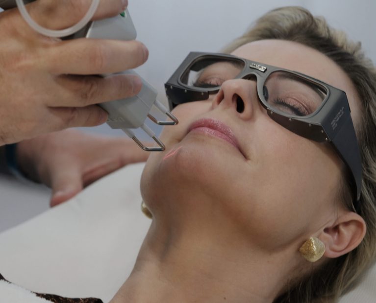 Žena podstupuje laserové ošetrenie tváre s cieľom omladiť pleť a zlepšiť jej štruktúru a vzhľad.